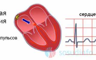 Синусоидная тахикардия сердца