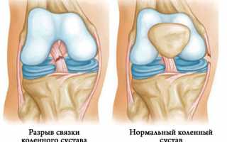 Разрыв коленных связок: признаки, диагностика и лечение