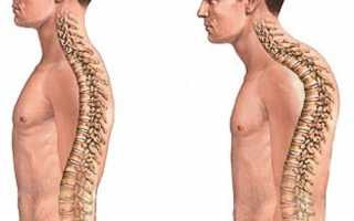 Кифоз грудного отдела позвоночника: как исправить