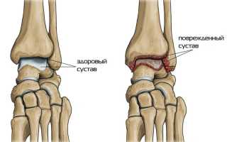 Артрит голеностопного сустава: как лечить