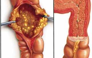 Псевдомембранозный колит: симптомы и лечение у взрослых