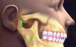 Артрит височно-нижнечелюстного сустава (ВНЧС): код МКБ-10, причины развития и симптомы заболевания
