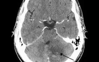 Мозжечковые артерии лечение