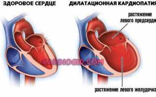 Дилатационная кардиомиопатия внезапная смерть