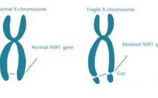 Синдром ломкой Х хромосомы, Мартин Белл