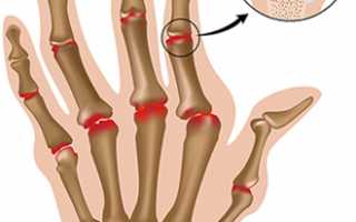 Ревматоидный артрит: признаки, причины и методы лечения