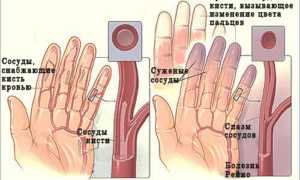 Болезнь (синдром) Рейно причины, симптомы, диагностика, лечение