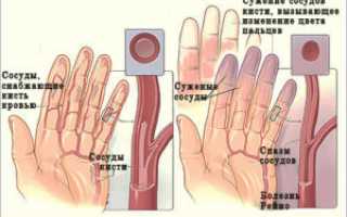 Болезнь (синдром) Рейно причины, симптомы, диагностика, лечение