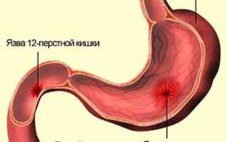 Симптомы язвы желудка у взрослых и способы лечения