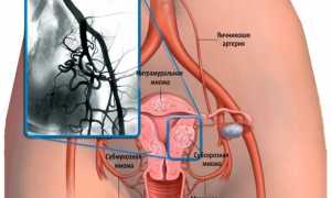Эмболизация маточных артерий противопоказания