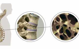 Системный остеопороз: код по МКБ-10, симптомы и лечение