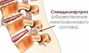 Cпондилоартроз: что это такое, степени, признаки и причины