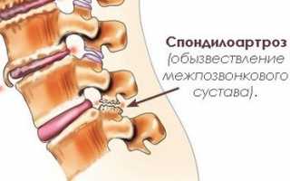 Cпондилоартроз: что это такое, степени, признаки и причины