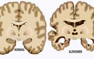 Синдром Альцгеймера: причины, симптомы, диагностика