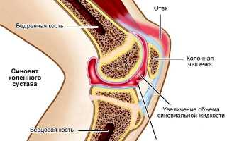 Синовит коленного сустава: причины развития, код по МКБ-10, симптомы и лечение