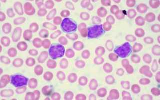 Повышенные лимфоциты в крови что это значит