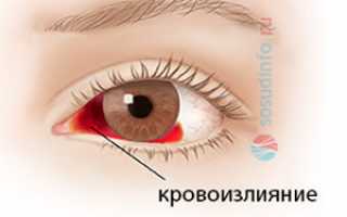 Глаза налитые кровью причины