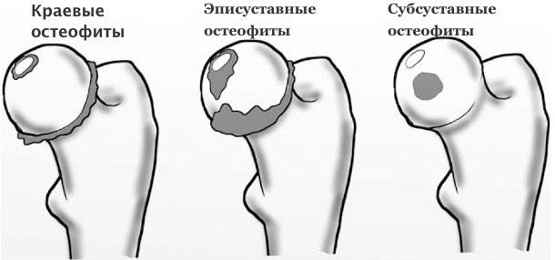 Остеофиты виды